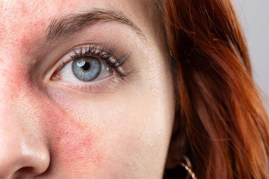 Rosacea